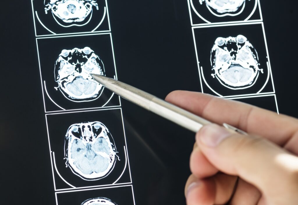 A close up of a physician's hand pointing with a pen at results from a brain MRI scan in Miami Beach.